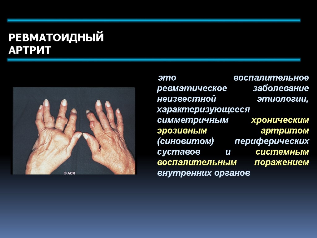 это воспалительное ревматическое заболевание неизвестной этиологии, характеризующееся симметричным хроническим эрозивным артритом (синовитом) периферических суставов